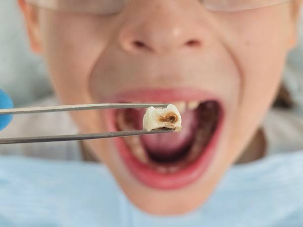 Best Emergency Root Canal Treatment in Deenwood, GA
